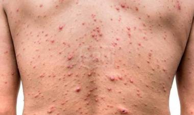 INFECTÓLOGO HUGO PIZZI "La Viruela del Mono no se acercará a lo que fue el Covid-19"