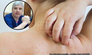 DR. ALEJANDRO AMARILLA: VARICELA “ES NORMAL QUE APAREZCAN ALGUNOS CASOS”