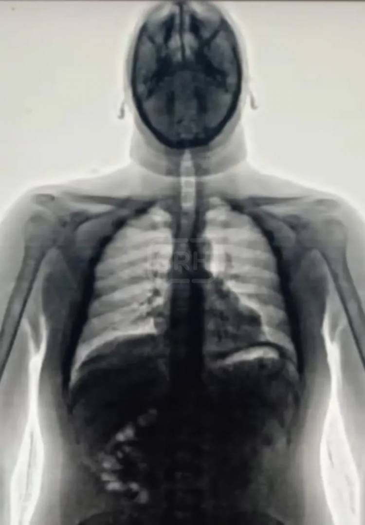 Chaco: presos fueron descubiertos con 60 cápsulas de droga en el cuerpo